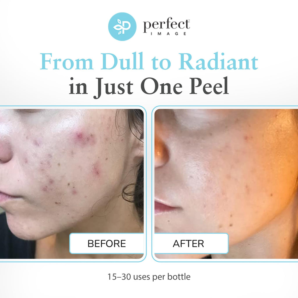 Perfect Image Glycolic 30% Gel Peel – Retinol & Green Tea, 1 oz | Professional Chemical Peel