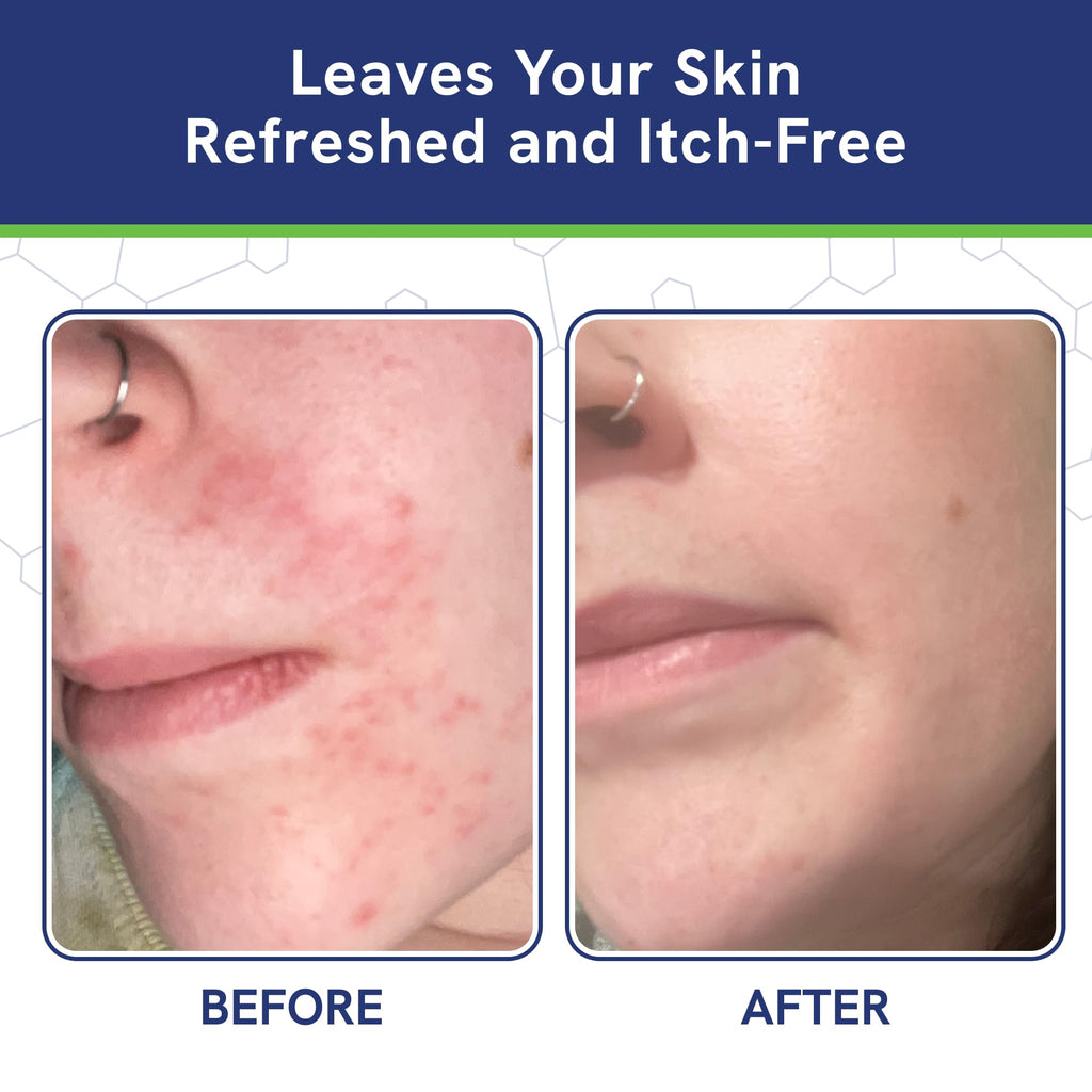 pHat 5.5 Seborrheic Dermatitis Moisturizing Cream & Face Lotion – Hydration, Redness Relief & Anti-Itch (2oz)