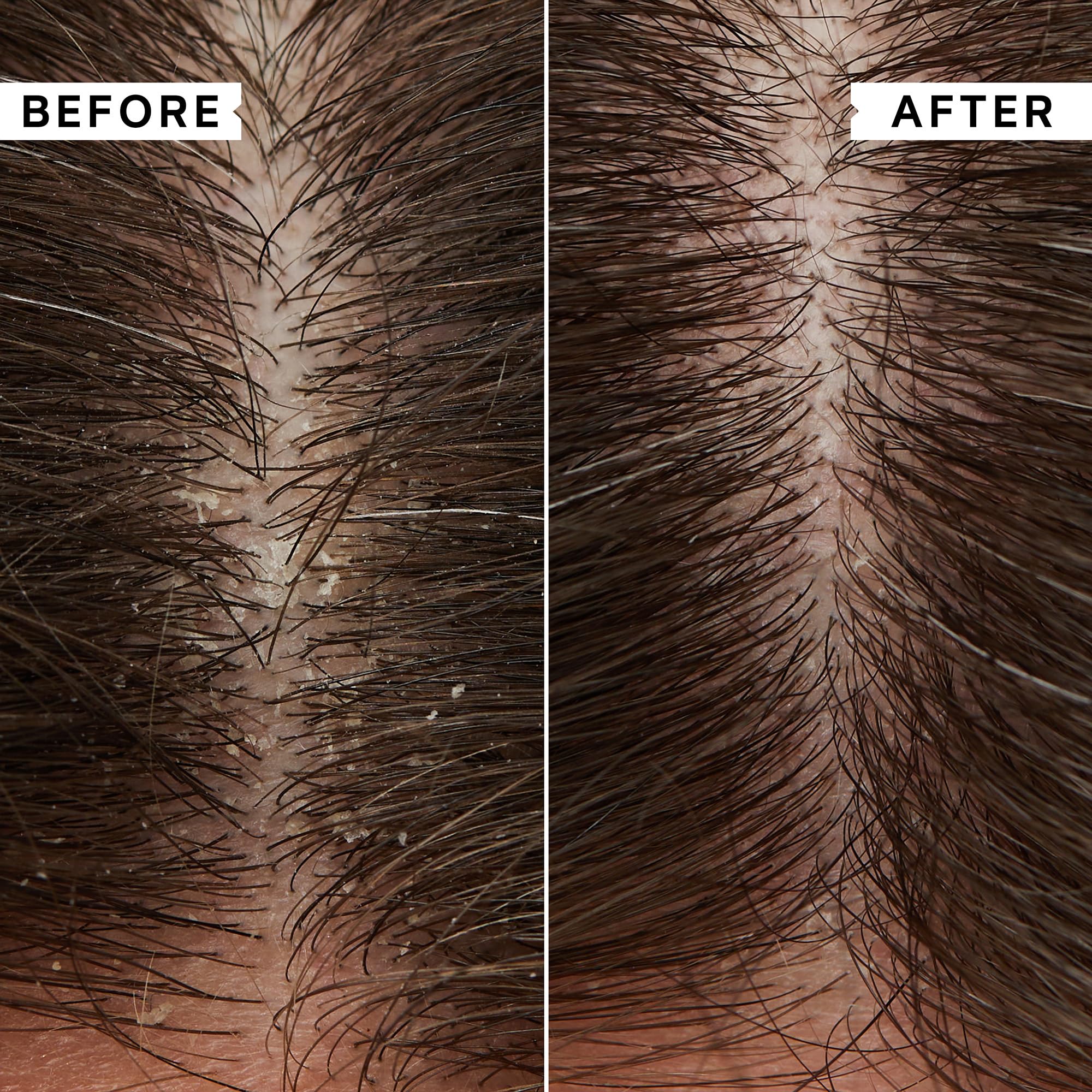 Philip Kingsley Flaky Scalp Shampoo | Hydrating, Calming Care for Flaky, Itchy, Dry or Oily Scalps | 1L Pump