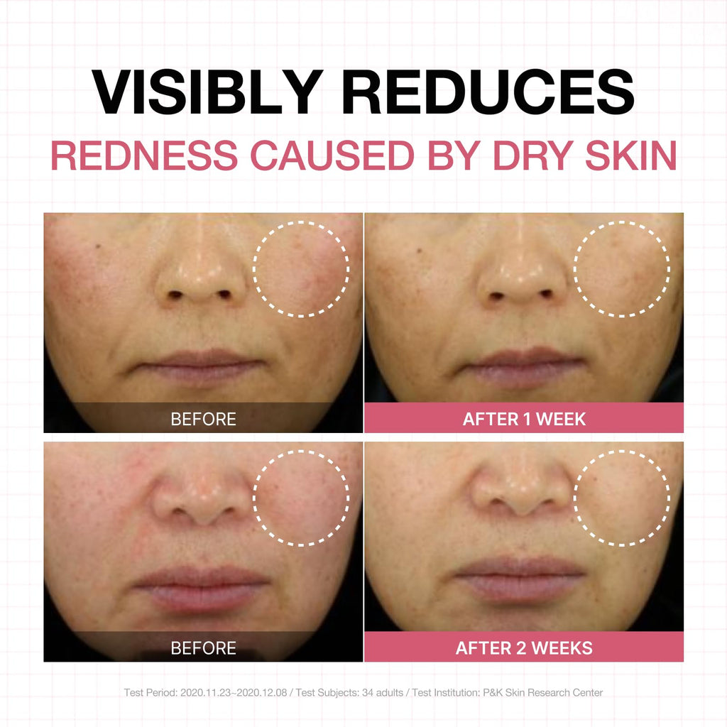 PHYSIOGEL Calming Relief Lotion Reduces Redness in 3 Days for Sensitive Skin
