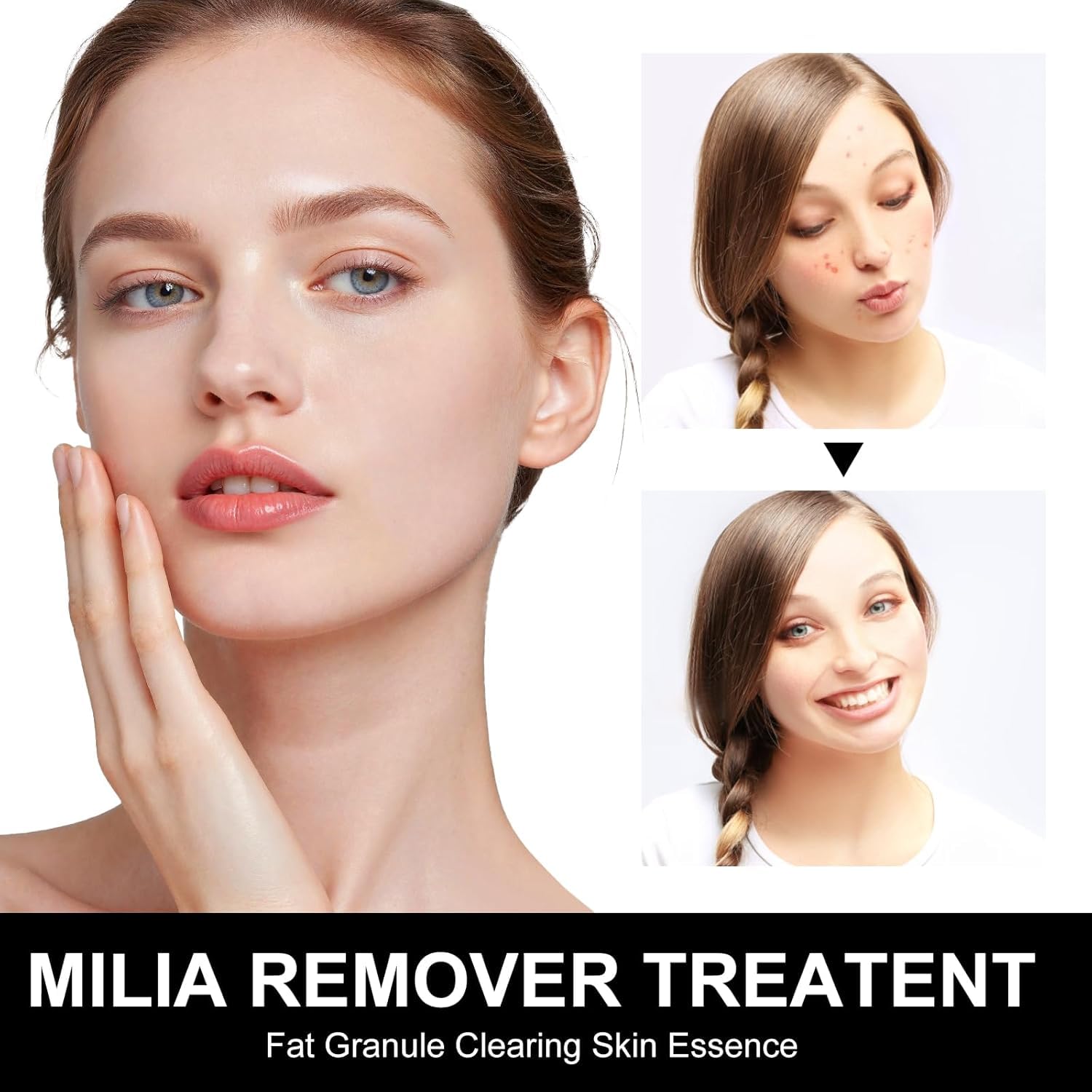 Platicat Milia Remover Serum – Clear Skin Spot Treatment (30ml, 1 Count, Black)