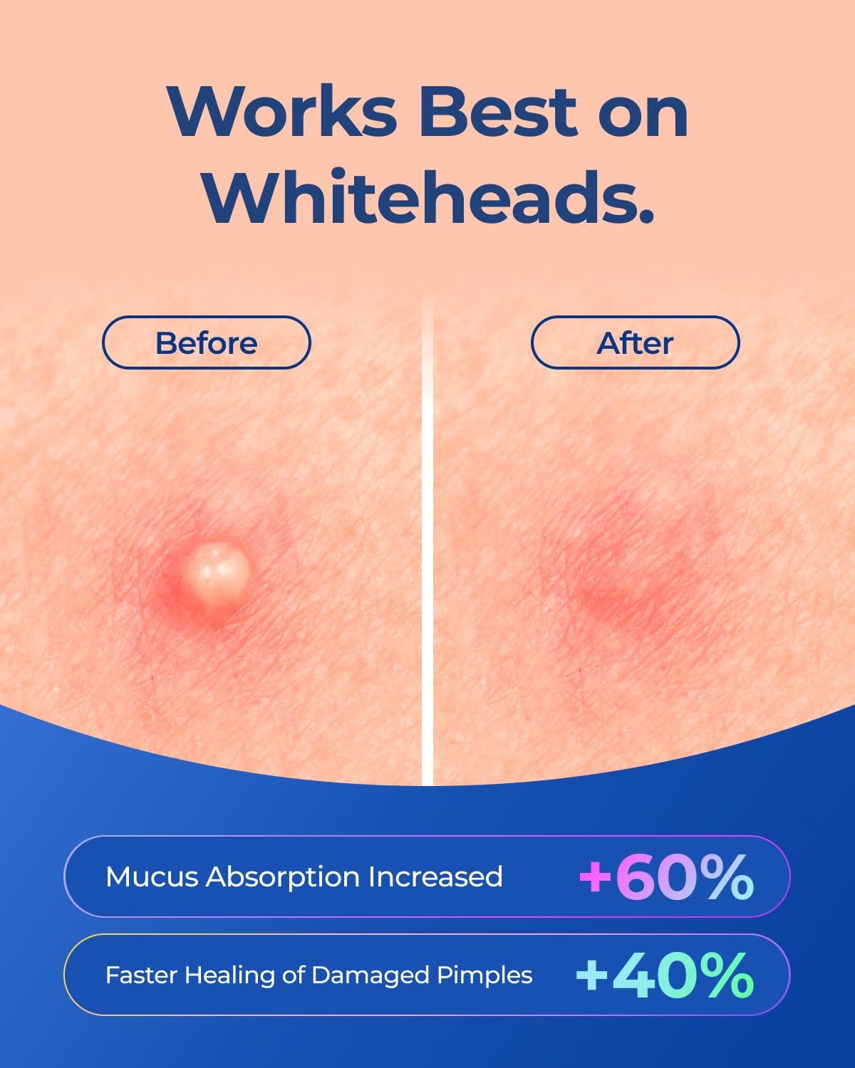 POINTMASS Star Pimple Patches – 6 Colors, 312 Patches, Overnight Care