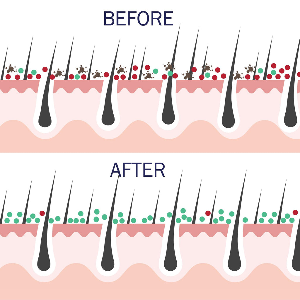 Probiotic Action Clarity in Balance: Science-Backed Bacteria for Acne, Rosacea & Eczema Risk