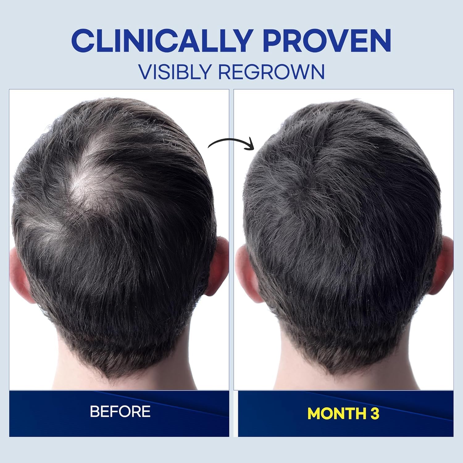 ProBliva 5% Minoxidil for Men Spray – Extra Strength Hair Growth Solution (2 fl oz, Made in USA)