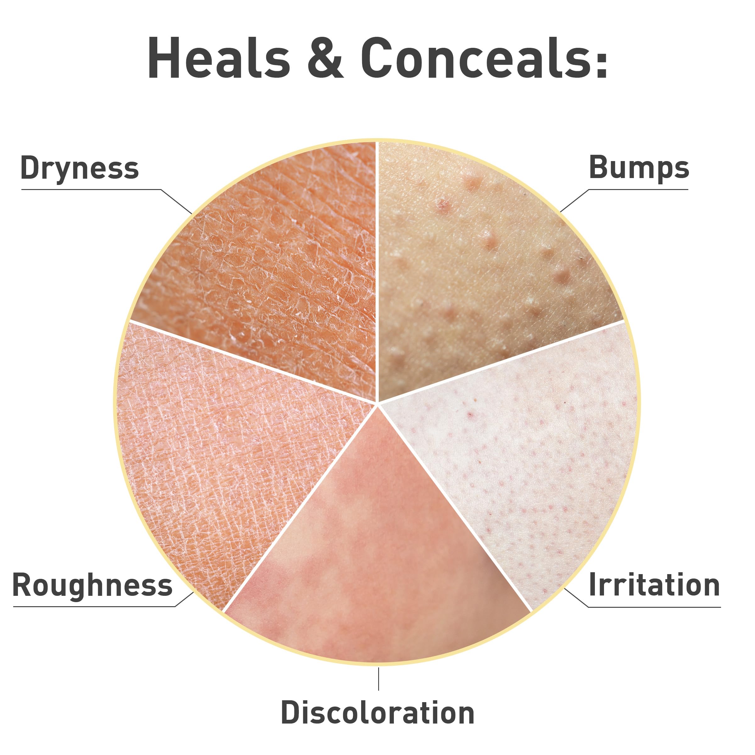 PROcure Keratosis Pilaris Cream — Gentle KP Solution for Smoother, Hydrated Skin