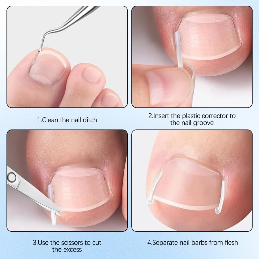 Professional Pedicure Tools Ingrown Toenail Kit – 4-Piece Set with Breathable Corrector Strips, Curved Patches, File & Lifters