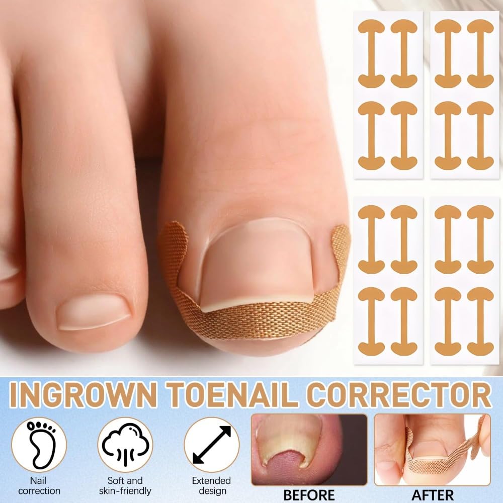 Professional Pedicure Tools Ingrown Toenail Kit – 4-Piece Set with Breathable Corrector Strips, Curved Patches, File & Lifters