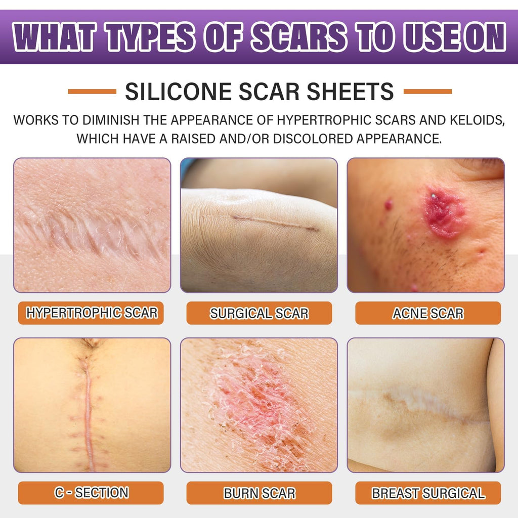 Psecici Silicone Scar Sheets Roll – Medical-Grade, Reusable Scar Tape for Surgical, C-Section, Tummy Tuck & Keloids (1.6" x 157" Roll)
