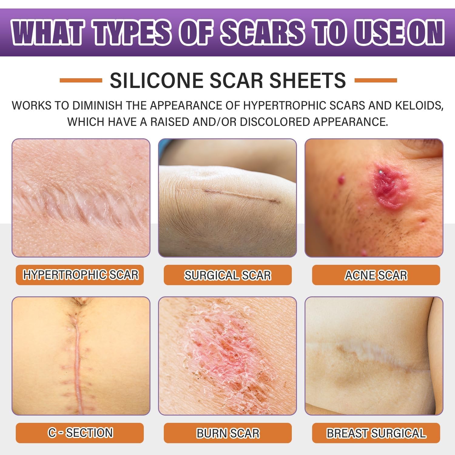 Psecici Silicone Scar Sheets Roll – Medical-Grade, Reusable Scar Tape for Surgical, C-Section, Tummy Tuck & Keloids (1.6" x 157" Roll)