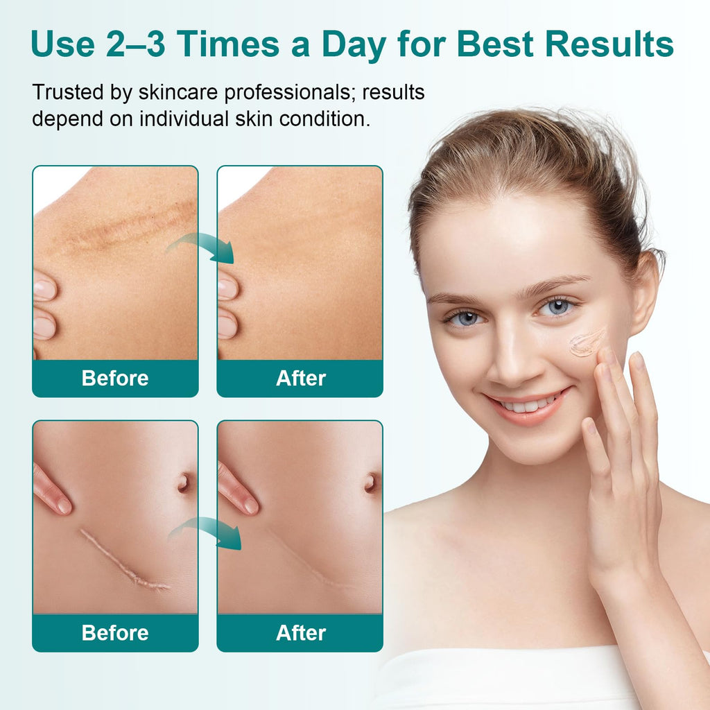 Pumkot Scar Cream Silicone Gel – Clinically Proven Scar Reduction, 1.76 oz