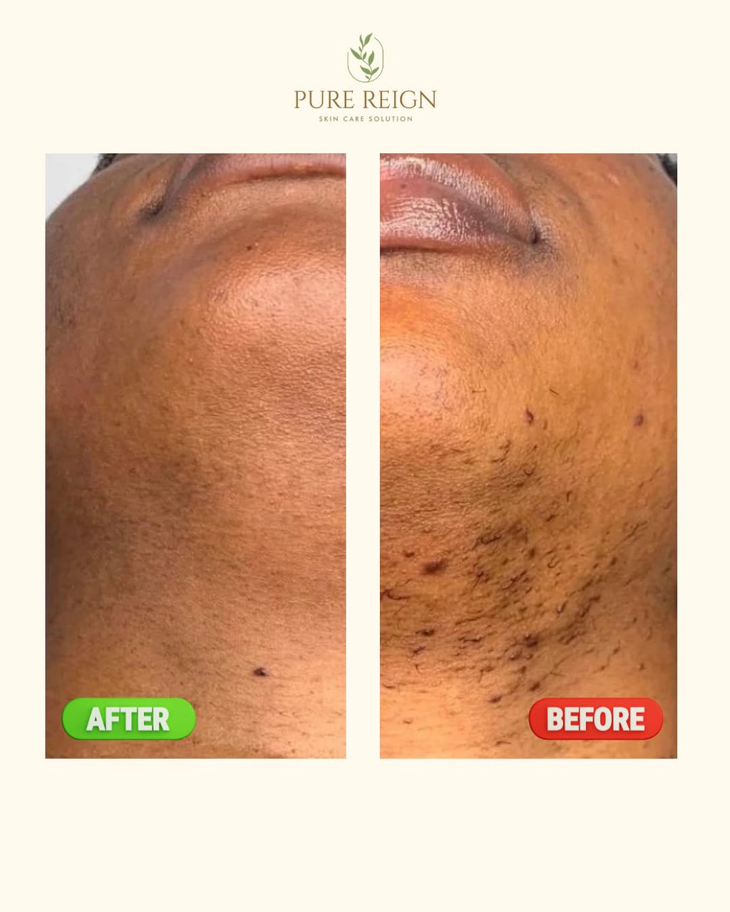 Pure Reign Skin Care Solution | Ingrown Hairs, Razor Bumps & Shaving Aftercare | 5oz (150ml)