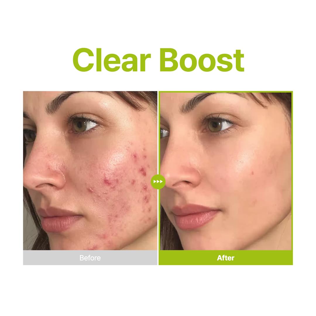 PURITO Azelaic Acid 10% + Kojic Acid + Tea Tree Serum – Acne & Marks (30mL)