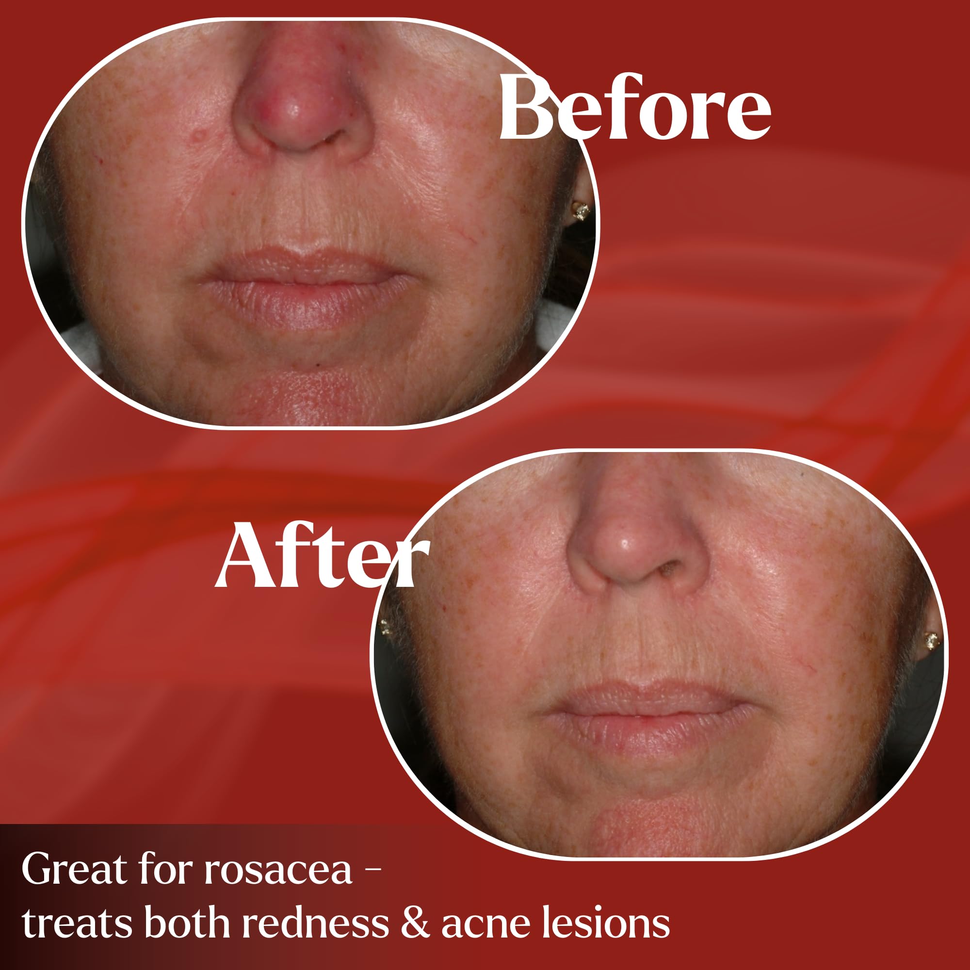 PyratineXR Creme – Antiaging & Rosacea Skin Treatment (2 oz)
