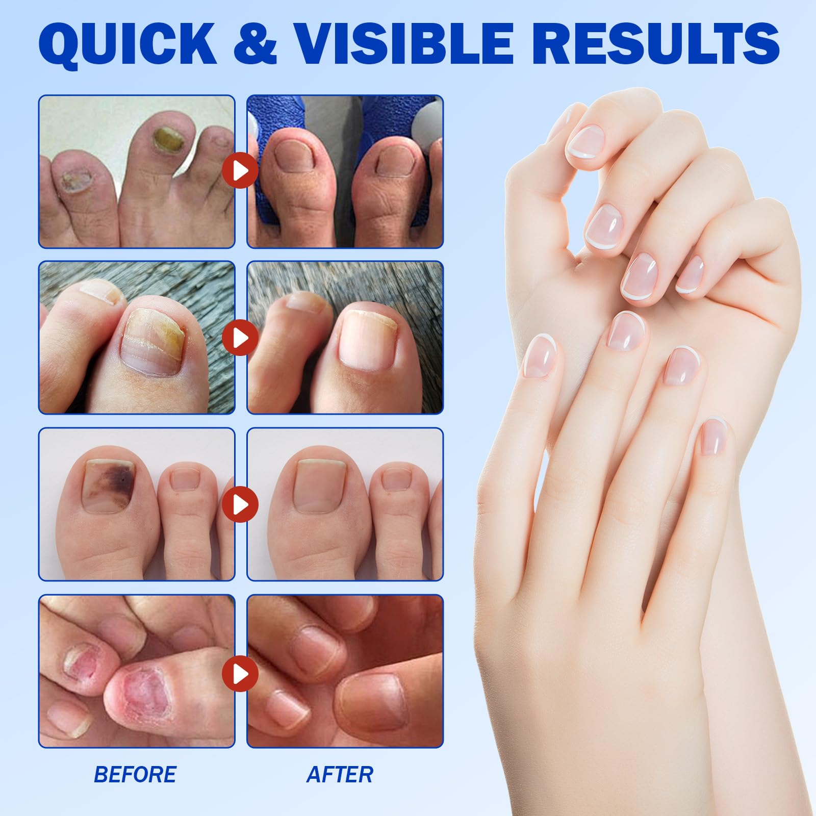 Qing Yo Nail Patches – 21 Pcs Overnight Nail Repair, Extra-Strength Patches for Thick, Discolored Nails