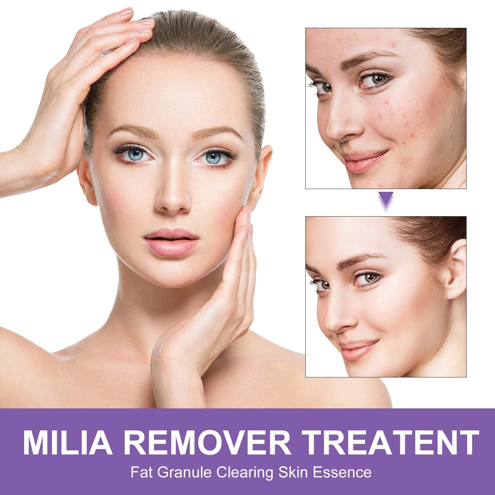 QKDBLWX Milia Remover for Eyes & Face — Salicylic Acid Milia Spot Treatment & Acne Cream