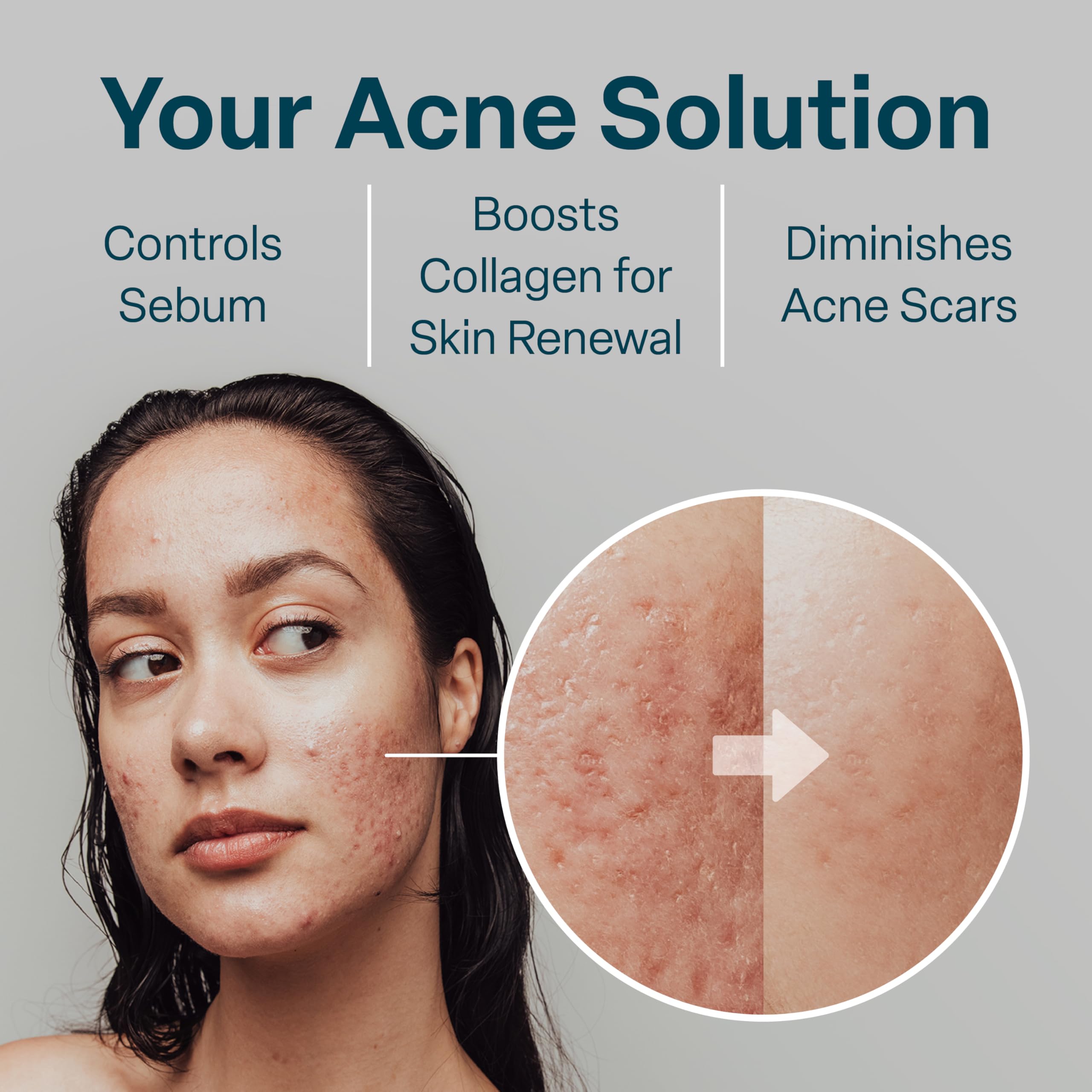 QRxLabs Salicylic & Glycolic Acid Acne Clearing Pads - 2% Salicylic, 10% Glycolic - 50 Count