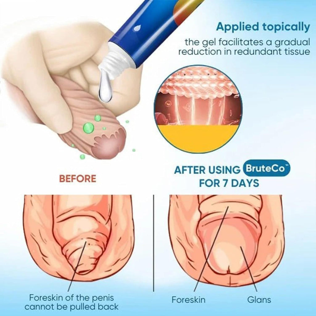 RCSCBC Redundant Prepuce Corrector Gel – Professional Quick Effect (2PCS)