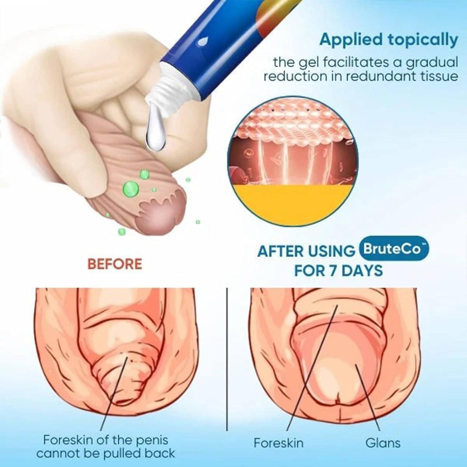 RCSCBC Redundant Prepuce Corrector Gel – Professional Quick Effect (2PCS)