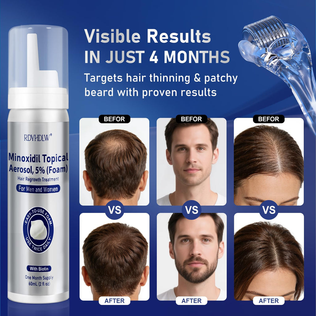 RDVHDLW 5% Minoxidil Foam for Hair Growth – Men & Women, 7-Month Supply (7x60ml)