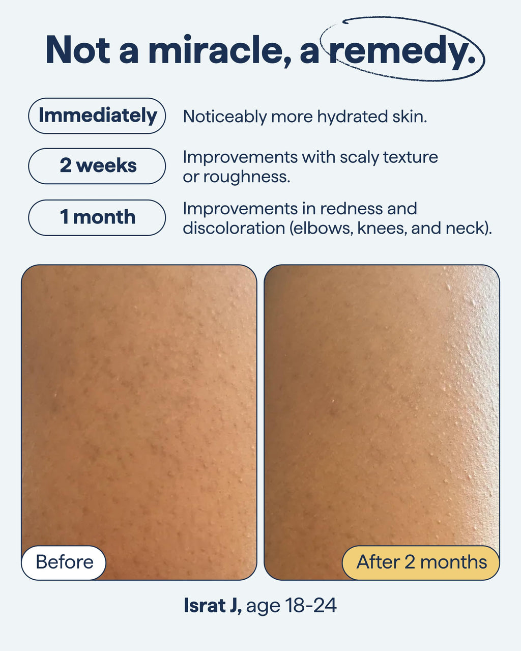 Remedy Science KP Exfoliating Body Moisturizer – Keratosis Pilaris Treatment by Dr. Shah