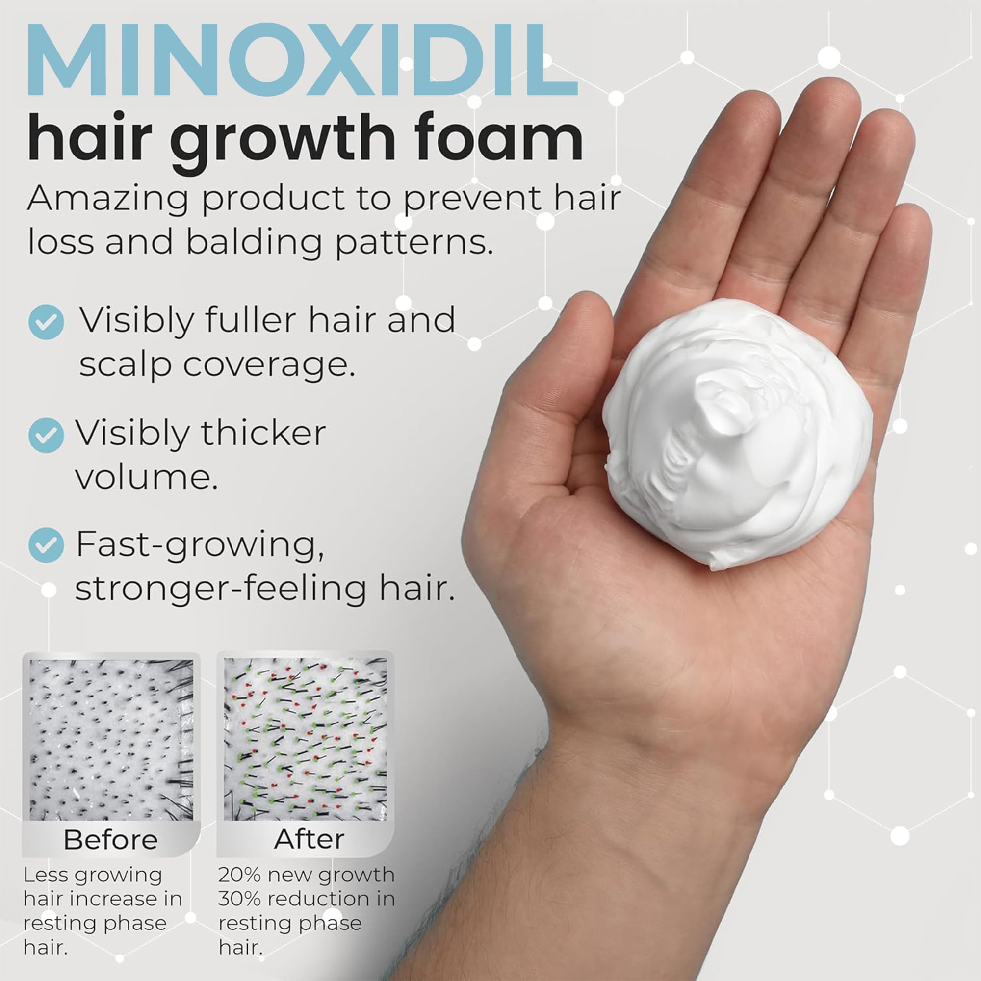 Remixidil Men’s 5% Minoxidil Foam – Hair Regrowth for Men | 3-Month Supply | Rida Hair Research Institute