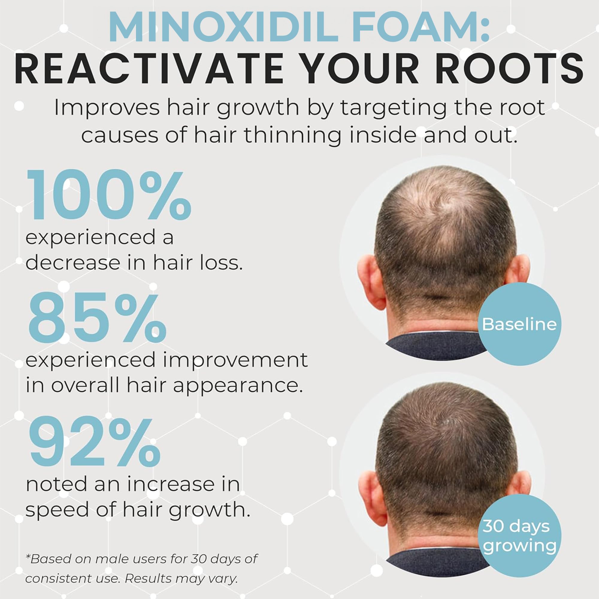 Remixidil Men’s 5% Minoxidil Foam – Hair Regrowth for Men | 3-Month Supply | Rida Hair Research Institute