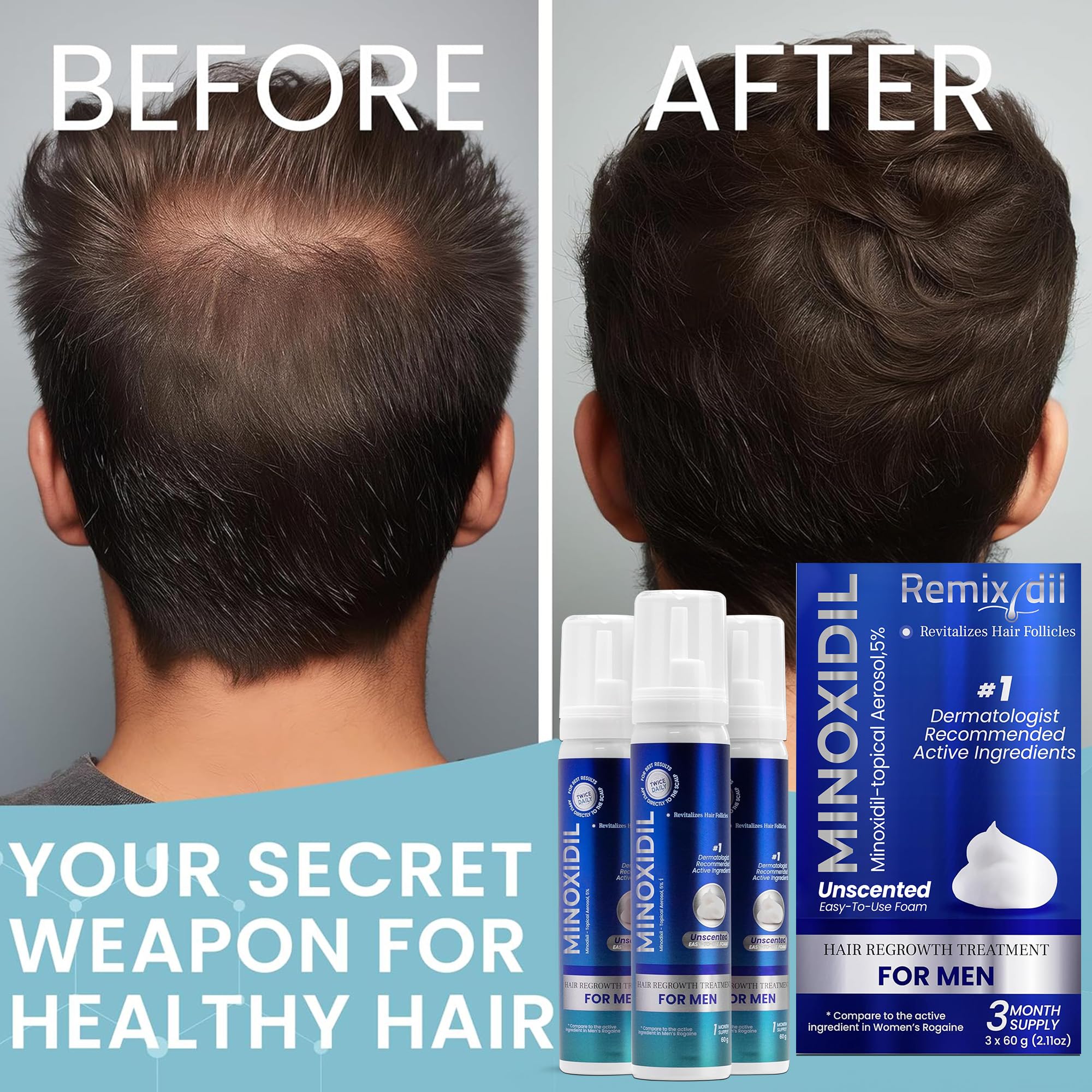 Remixidil Men’s 5% Minoxidil Foam – Hair Regrowth for Men | 3-Month Supply | Rida Hair Research Institute