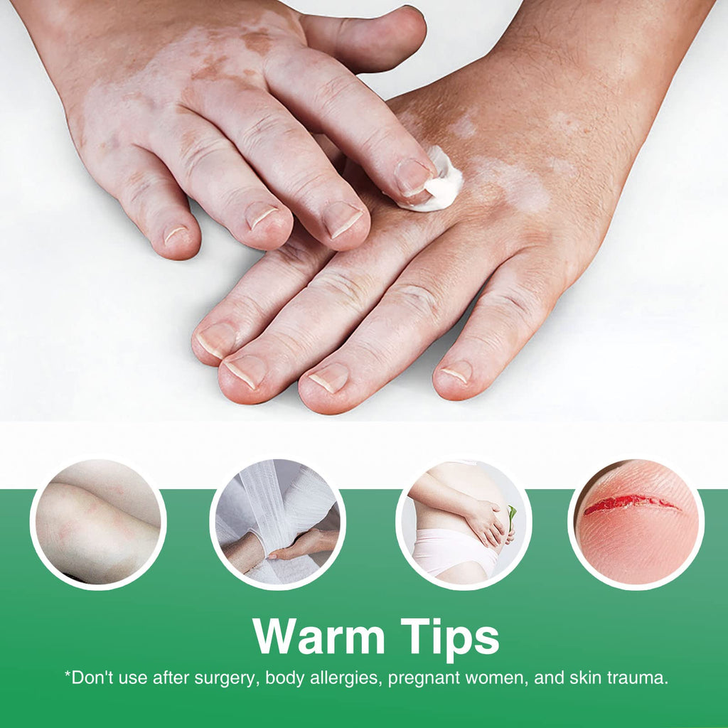Richie House Vitiligo Cream – Natural Formula to Support Even Skin Tone