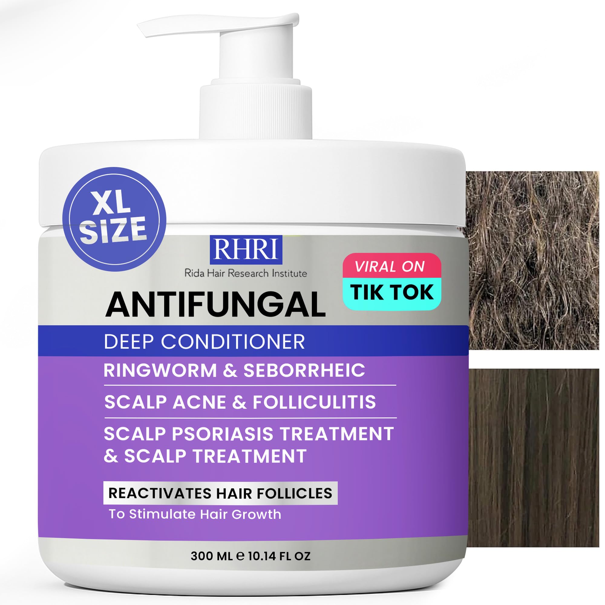 Rida Hair Research Institute Anti Fungal Deep Conditioner – Scalp Care for Psoriasis, Dandruff & Dry Scalp