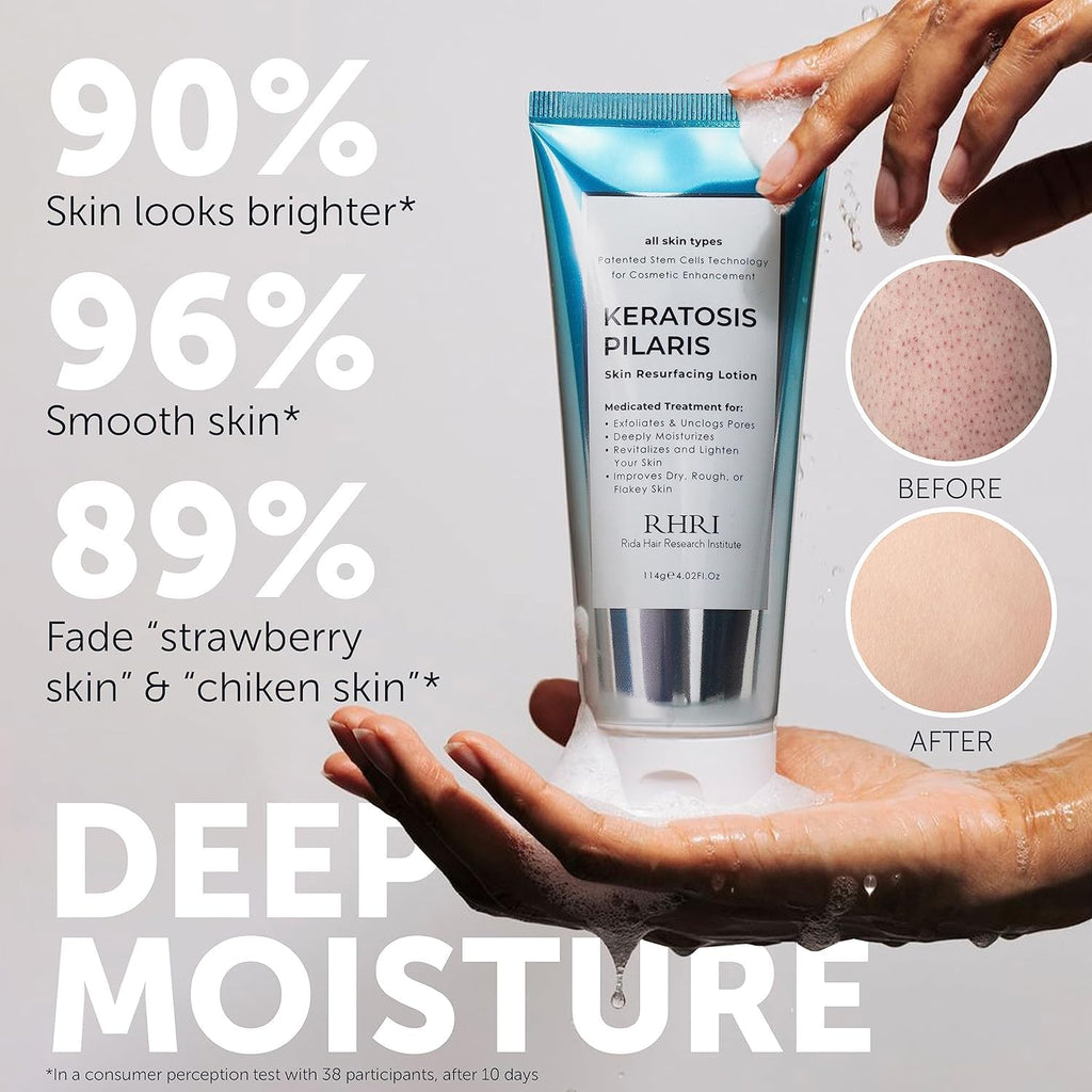 Rida Keratosis Pilaris Treatment – 10% AHA KP Lotion for Smooth, Hydrated Skin