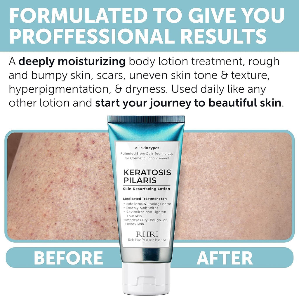 Rida Keratosis Pilaris Treatment – 10% AHA KP Lotion for Smooth, Hydrated Skin