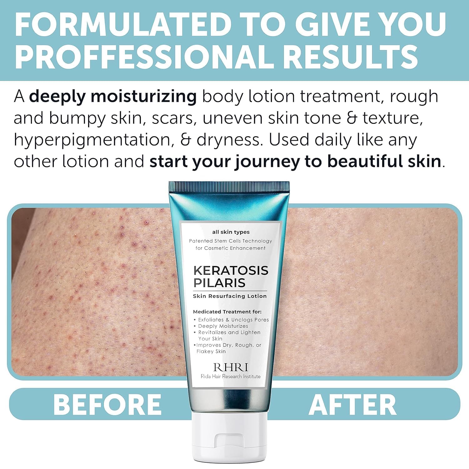 Rida Keratosis Pilaris Treatment – 10% AHA KP Lotion for Smooth, Hydrated Skin