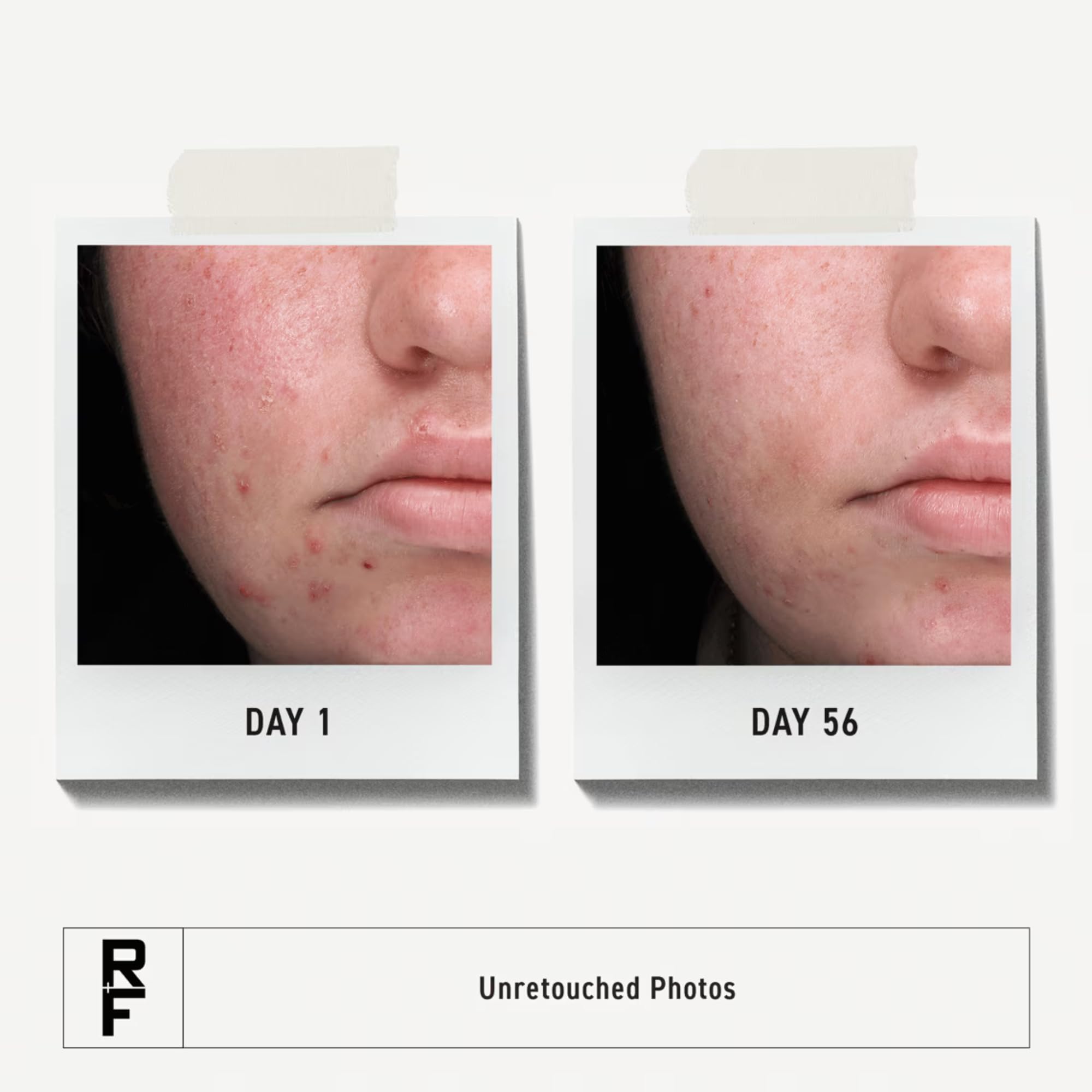 Rodan + Fields Spotless Regimen – Benzoyl Peroxide Face Wash for Sensitive Skin
