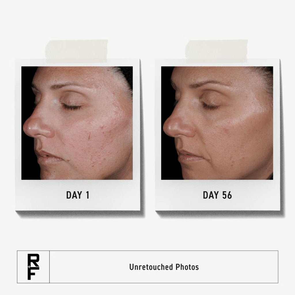 Rodan + Fields Unblemish Regimen – Acne Care Set with Cleanser, Toner, Treatment & SPF 30