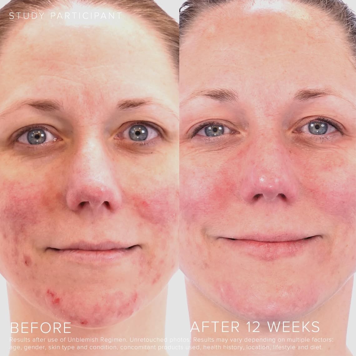 Rodan + Fields Unblemish Dual Intensive Acne Treatment | 0.76 Fl Oz | Targets Blemishes