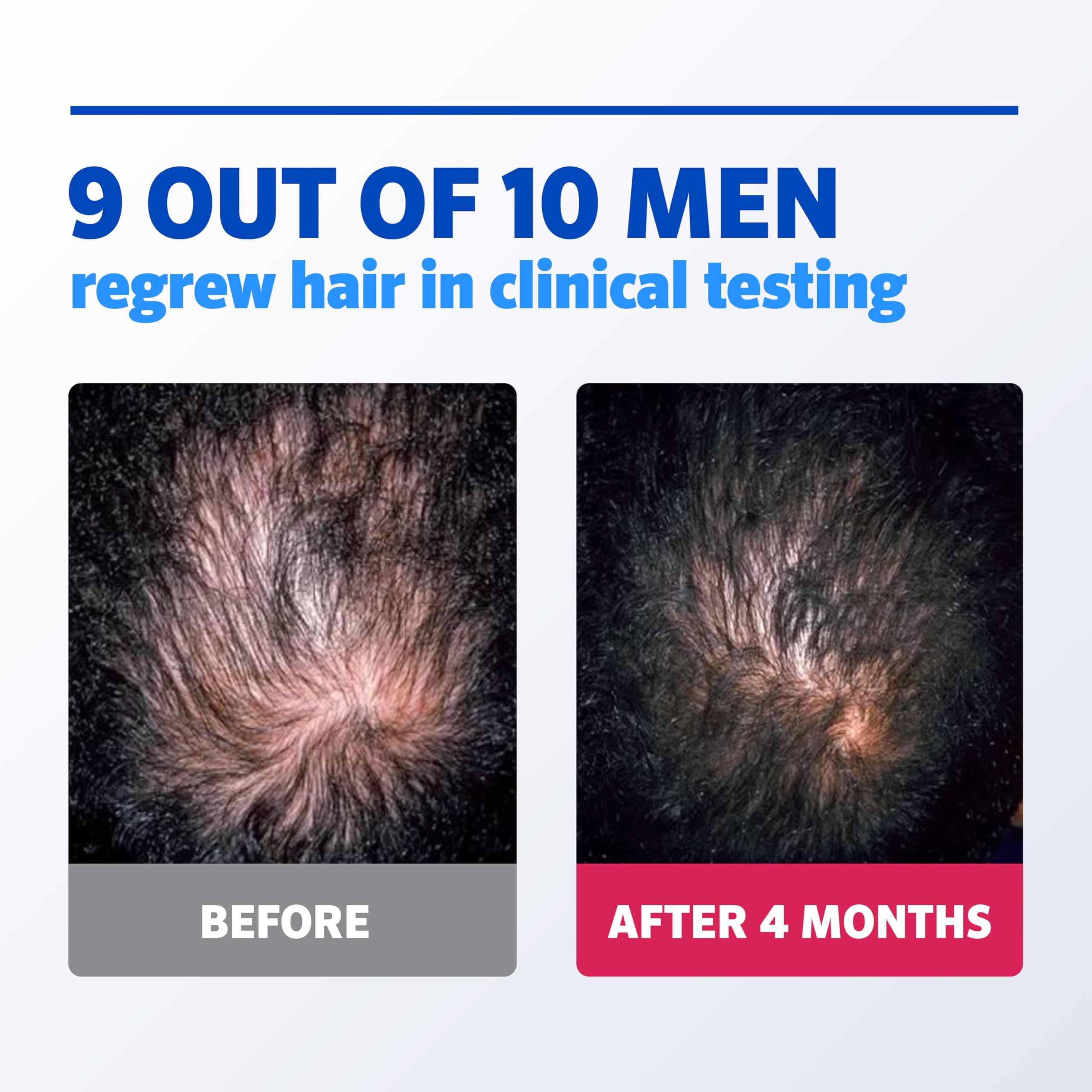 Rogaine Men’s 5% Minoxidil Foam for Hair Regrowth – Unscented, 3-Month Supply