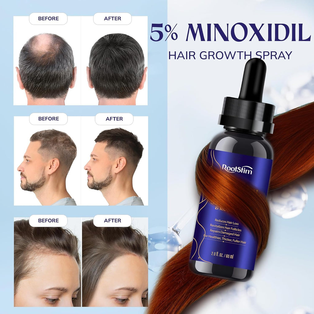 RootStim 5% Minoxidil Hair Growth Serum – Extra Strength with Rosemary, 2 oz (Beard & Hair Kit)
