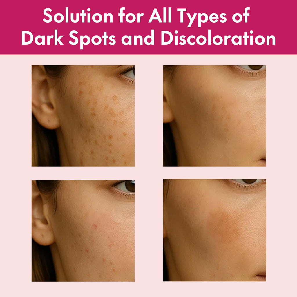 Roseblem Arbutin 7% + Tranexamic 4% Face Cream for Dark Spots & Even Tone – Hydrating & Gentle