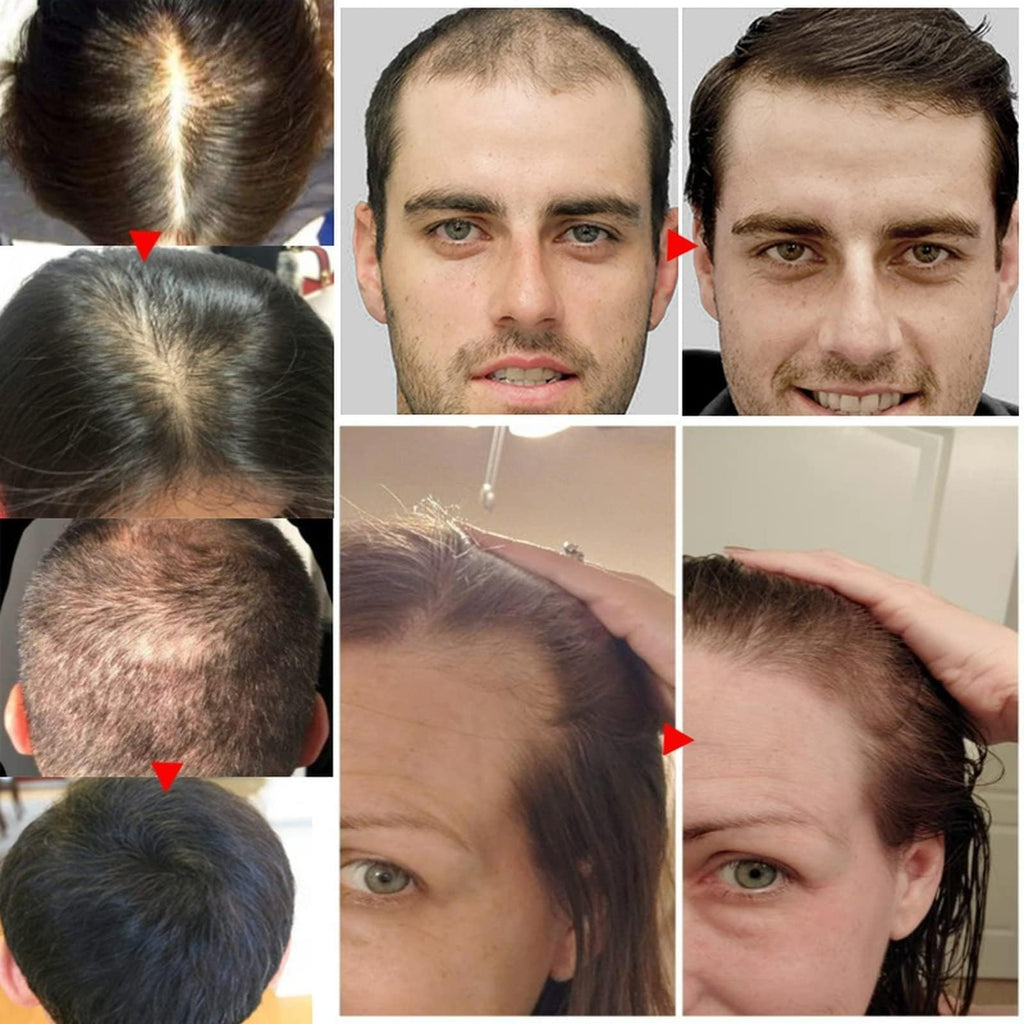 Rosemary Oil for Hair Growth & Treatment – 60 ml / 2.2 fl oz Dropper Bottle Pack (2 Units)