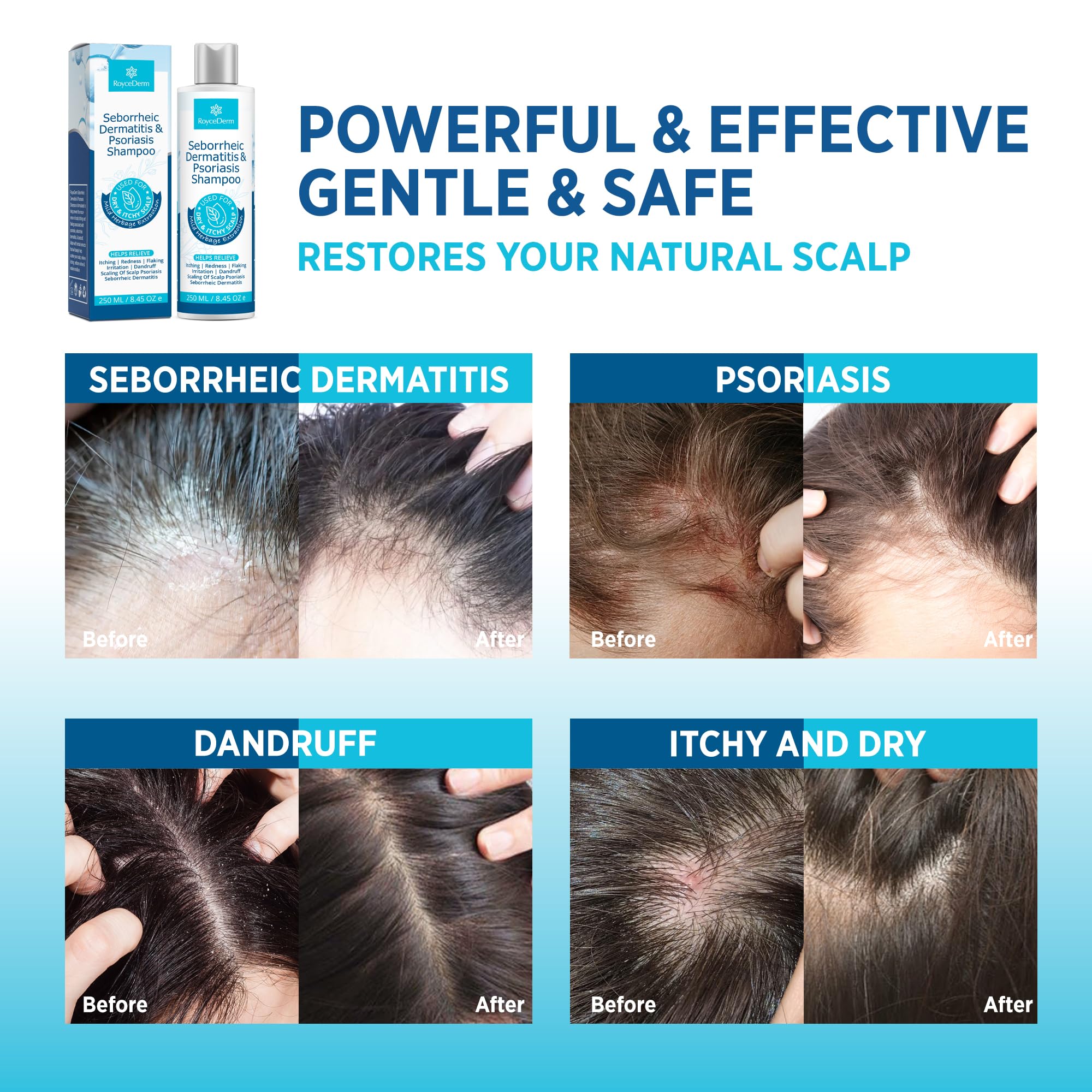 Roycederm Seborrheic Dermatitis & Psoriasis Face Cream – Steroid-Free, Fragrance-Free (4 oz)