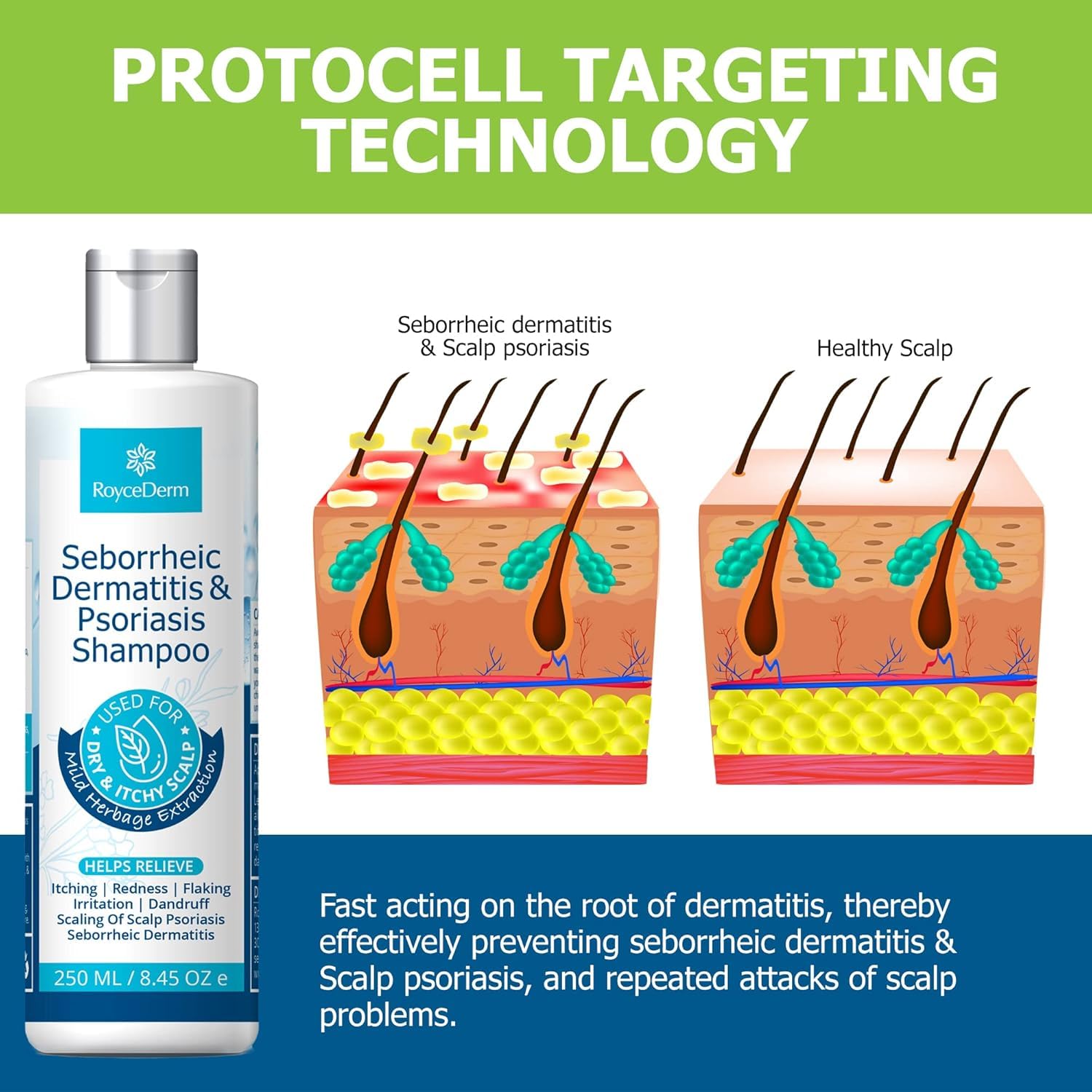 Roycederm Psoriasis & Seborrheic Dermatitis Shampoo – Itch Relief & Flake Control