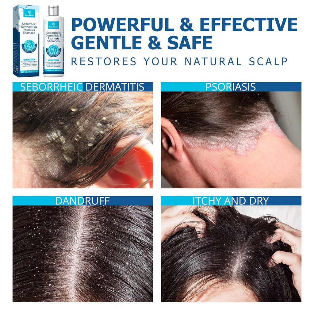 Roycederm Psoriasis & Seborrheic Dermatitis Shampoo – Itch Relief & Flake Control