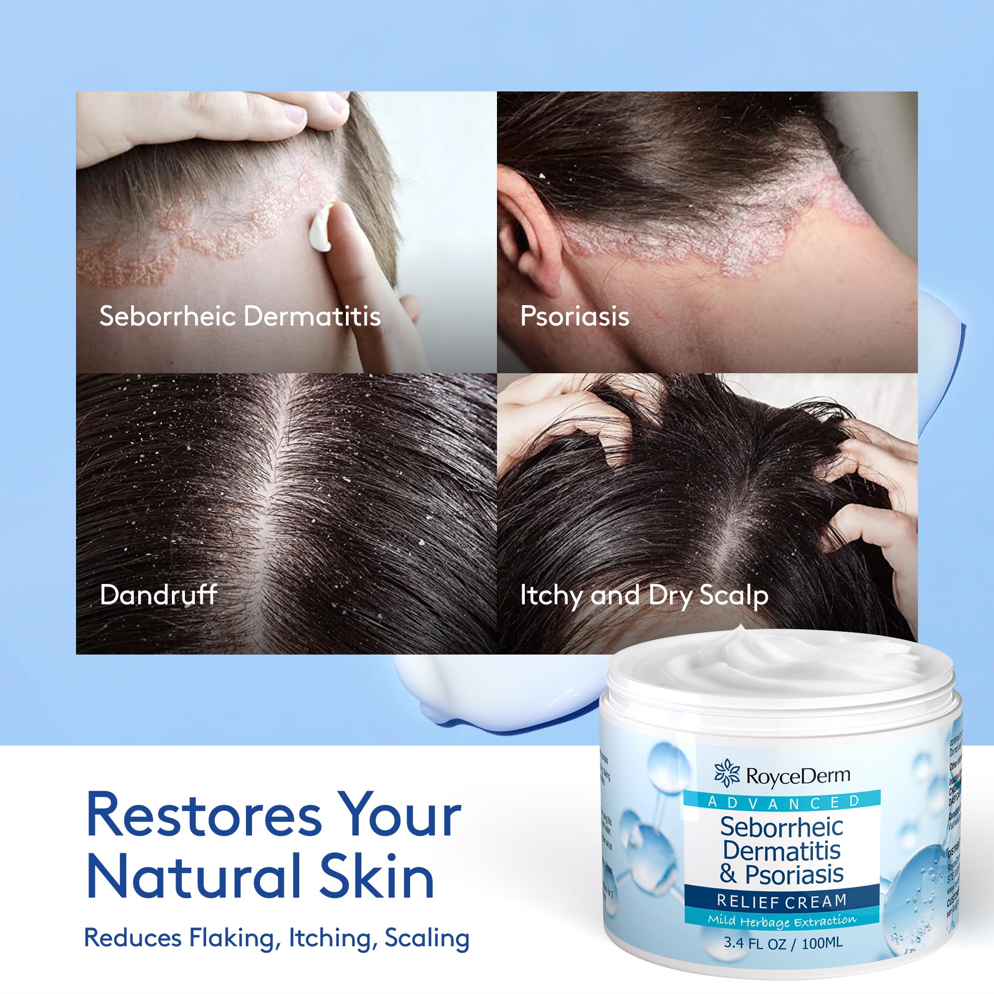 Roycederm Seborrheic Dermatitis & Psoriasis Scalp Treatment Kit – Shampoo and Cream for Dry Itchy Scalp