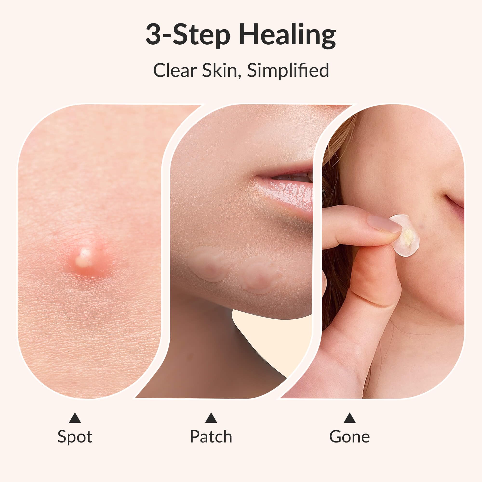 RPE Life Korean Pimple Patches – 36 Count, 4 Sizes, Hydrocolloid + Salicylic Acid