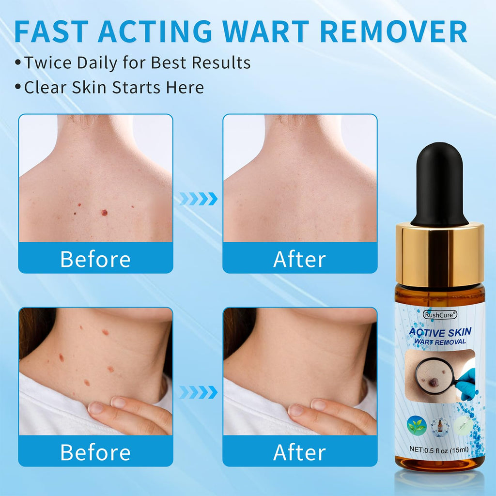 RushCure Wart Remover Serum — 17% Salicylic, Precision Dropper, Travel Size 0.5 oz