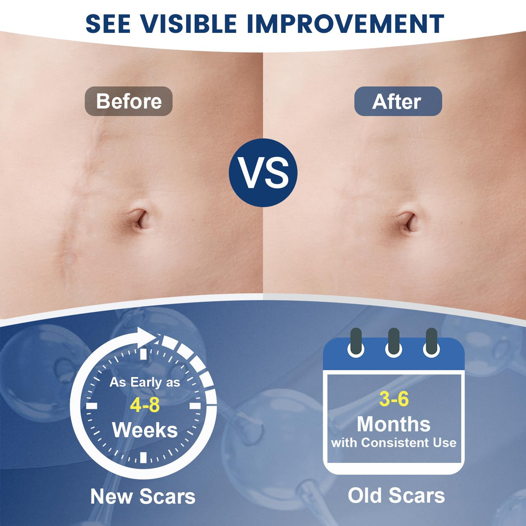 Rvlaim 100% Silicone Scar Gel – Advanced Scar Care, 1.7 oz (50 ml)