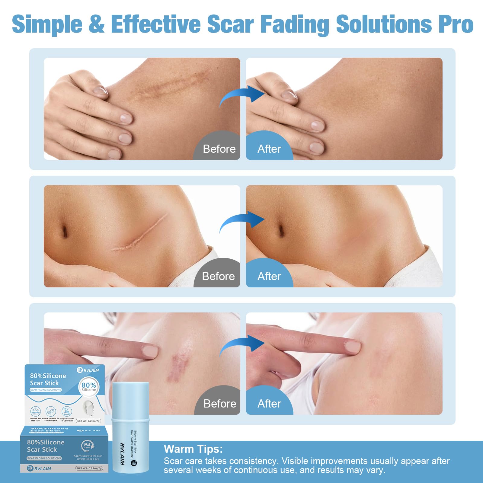 Rvlaim Silicone Scar Stick – 80% Medical-Grade Silicone, 7g for Face & Body