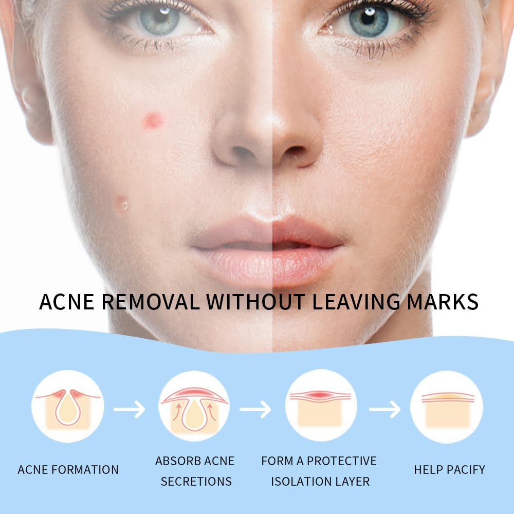 Safirst Star Acne Patches – Hydrocolloid Pimple Patches, 3 Sizes, 200 Count