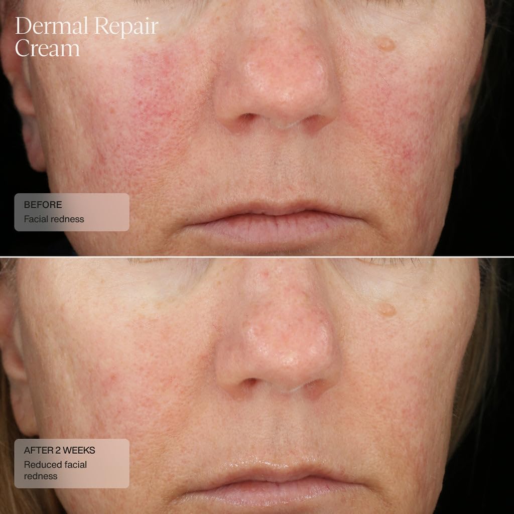 Sente Dermal Repair Facial Cream | Hydration & Soothing for Rosacea & Sensitive Skin