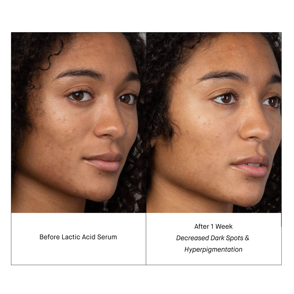 SHANI DARDEN Lactic Acid Serum | Travel Size Night Exfoliator for Radiant, Smooth Skin
